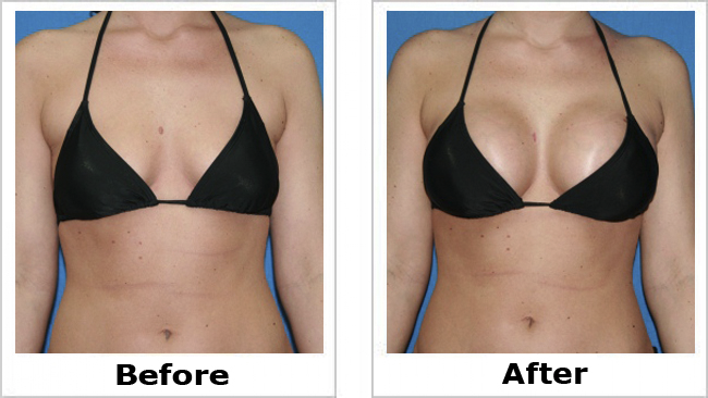 Consumer Lab Report Breast Enhancement